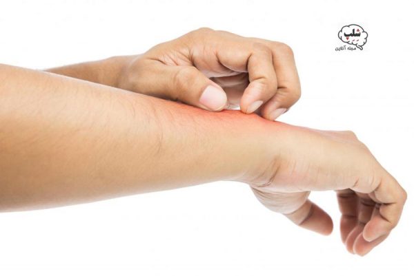 چرا به بدلیجات حساسیت دارم؟ چگونه حساسیت بدلیجات را از بین ببریم؟