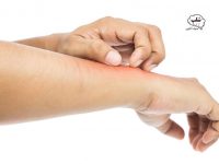 چرا به بدلیجات حساسیت دارم؟ چگونه حساسیت بدلیجات را از بین ببریم؟